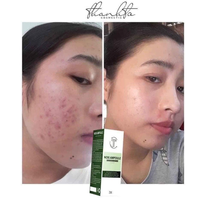 SERUM JIUHE ACNES NANO MỤN THANH TÔ CHÍNH HÃNG 100%