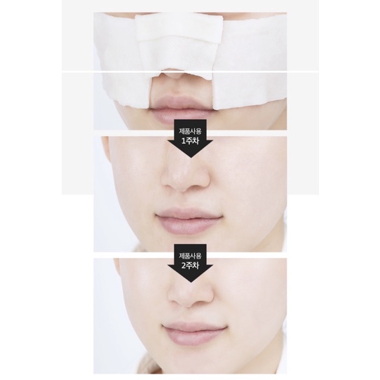 Ủ mụn Medipeel Super Extra 9