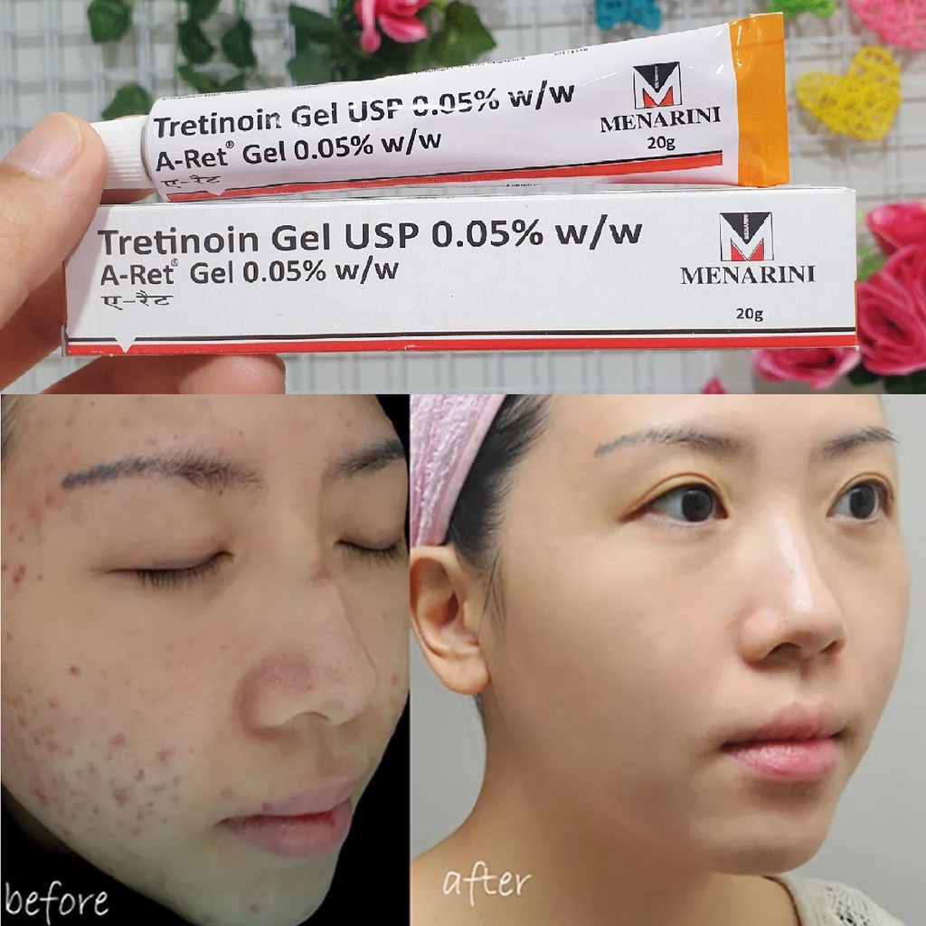 Tretinoin Gel USP Aret Menarini Giảm Mụn Chống Lão Hóa Da