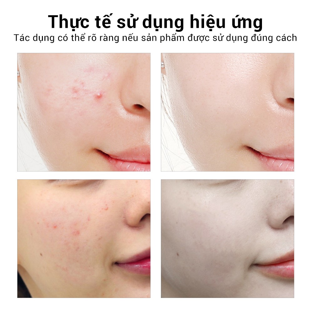 Serum hỗ trợ giảm Mụn BREYLEE Phục Hồi Làm Trắng Da 17ml