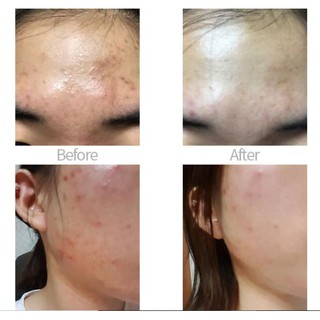 Kem dưỡng ac clear calming cream