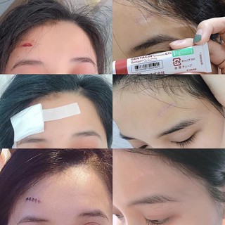 Kem mờ sẹo Gentaci 10g