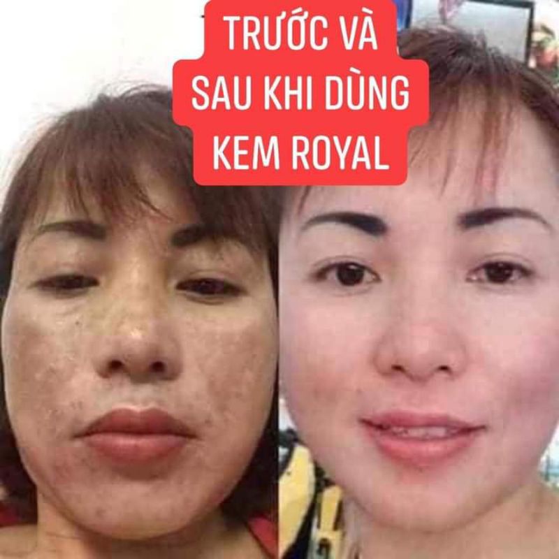 Kem nám Royal, dưỡng trắng, mờ nám,tàn nhang,thâm mụn