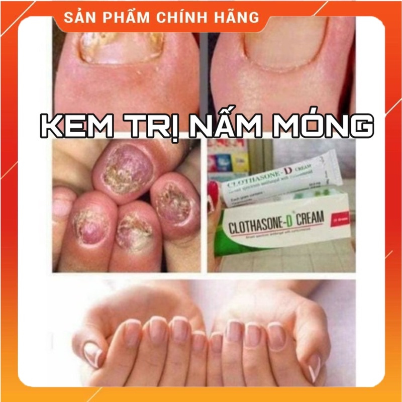 Kem Thoa Hỗ Trợ Giảm Nấm Móng Thái Lan 🇹🇭