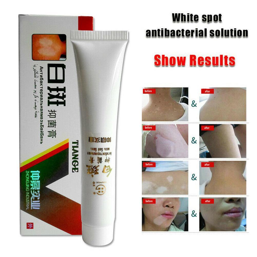 Kem dưỡng trắng da cao cấp Vitiligo 30g