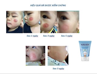Kem bôi Chàm Sữa cho cho bé- Kutieskin