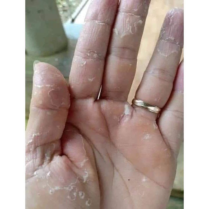 Bộ 2 tip nấm á sừng, vảy nến, tổ đỉa, mề đay, ghẻ ngứa, mề đay, dị ứng, hắc Lào | BigBuy360 - bigbuy360.vn