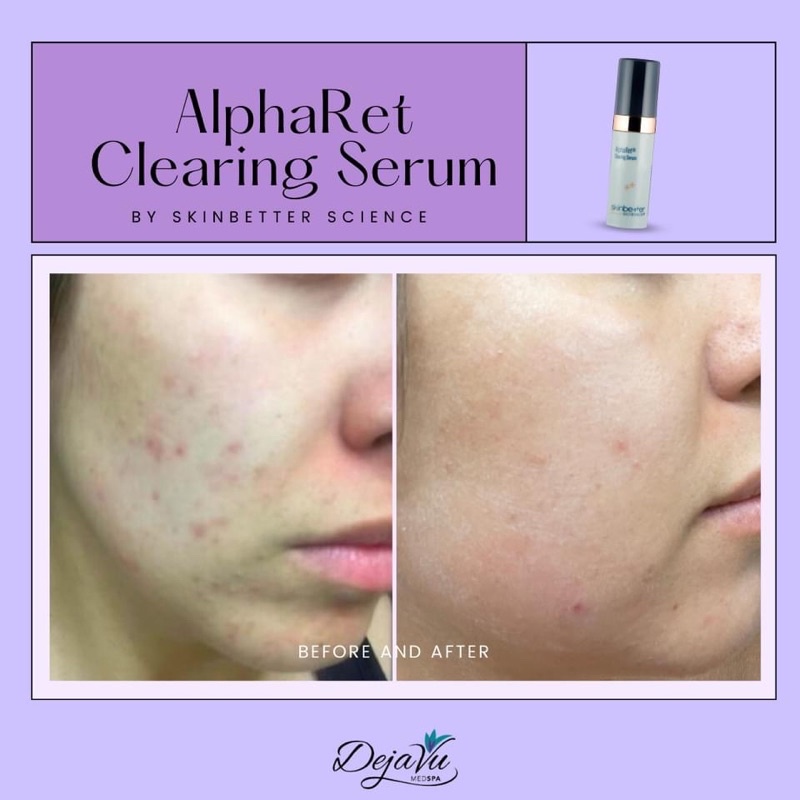 Serum SKINBETTER SCIENCE ALPHARET CLEARING