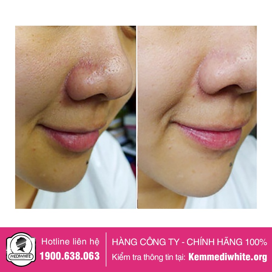 Kem Tẩy Tế Bào Chết Medi White Chính Hãng - Medi Fresh - Kem Tẩy Tế Bào Chết Sáng Da Medi White - Hàng Công Ty