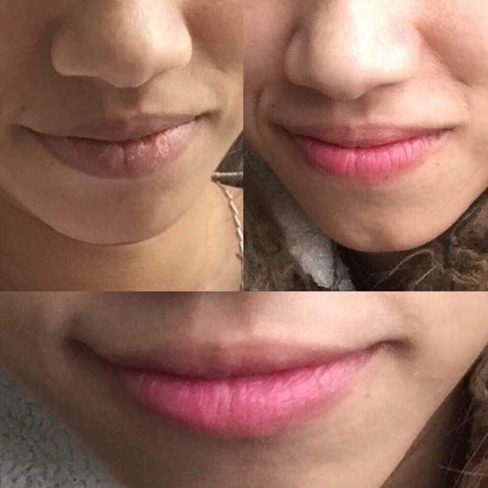 [FREESHIP] Kem khử thâm làm hồng môi Hàn Quốc Xxvirgin 5ml có tác dụng sau 5 ngày | BigBuy360 - bigbuy360.vn