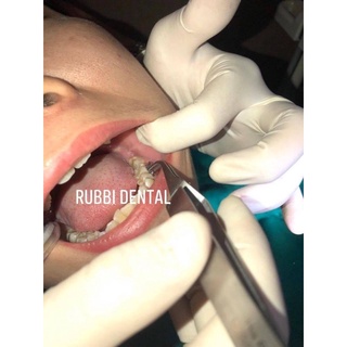 Mắc cài răng 6, răng 7 - Kẹp gắp mắc cài