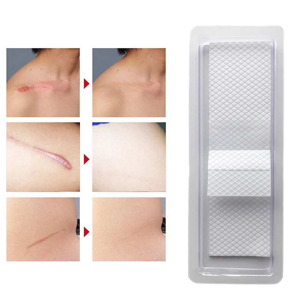 (Hàng Mới Về) Miếng Dán Silicone Trị Sẹo Tái Sử Dụng | BigBuy360 - bigbuy360.vn