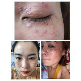 SÉT LẺ TCA CHẤM TÀN NHAN, SẸO RỔ