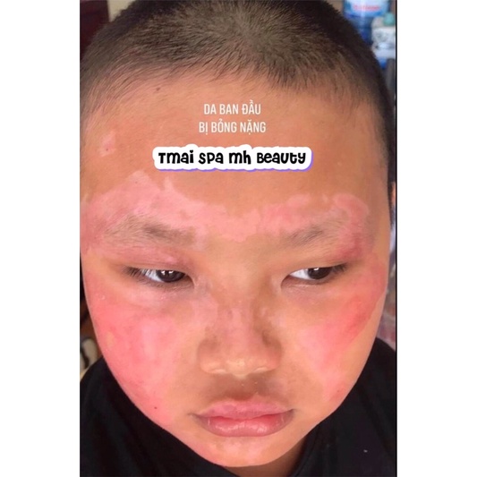 Serum  tinh chất mờ thâm liền sẹo MH Beauty spa