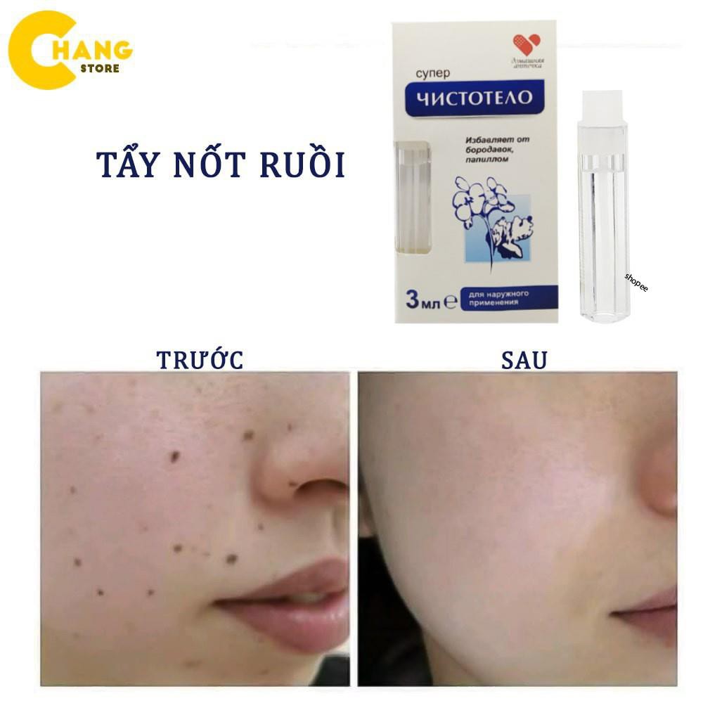 Thuốc tẩy nốt ruồi 💕FREESHIP💕 Thuốc xóa ruồi an toàn tại nhà của Nga