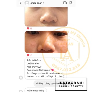 [HOT] Tinh chất nâng mũi Hàn Quốc