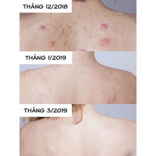 Xịt Hỗ Trợ Giảm Mụn Lưng For Back