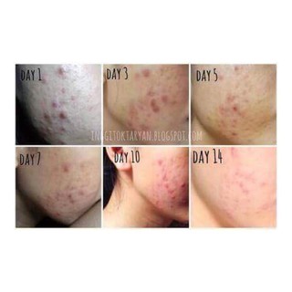 Tinh dầu chấm mụn Tea Tree oil