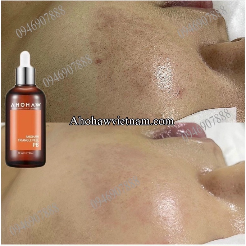 Dung dịch Peel PB Ahohaw