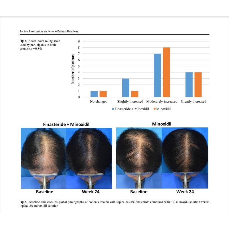 Xịt tóc Minoxidil 2%