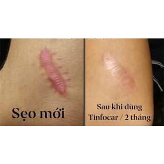 Tinfoscar - Gel mờ mẹo, mịn làn da