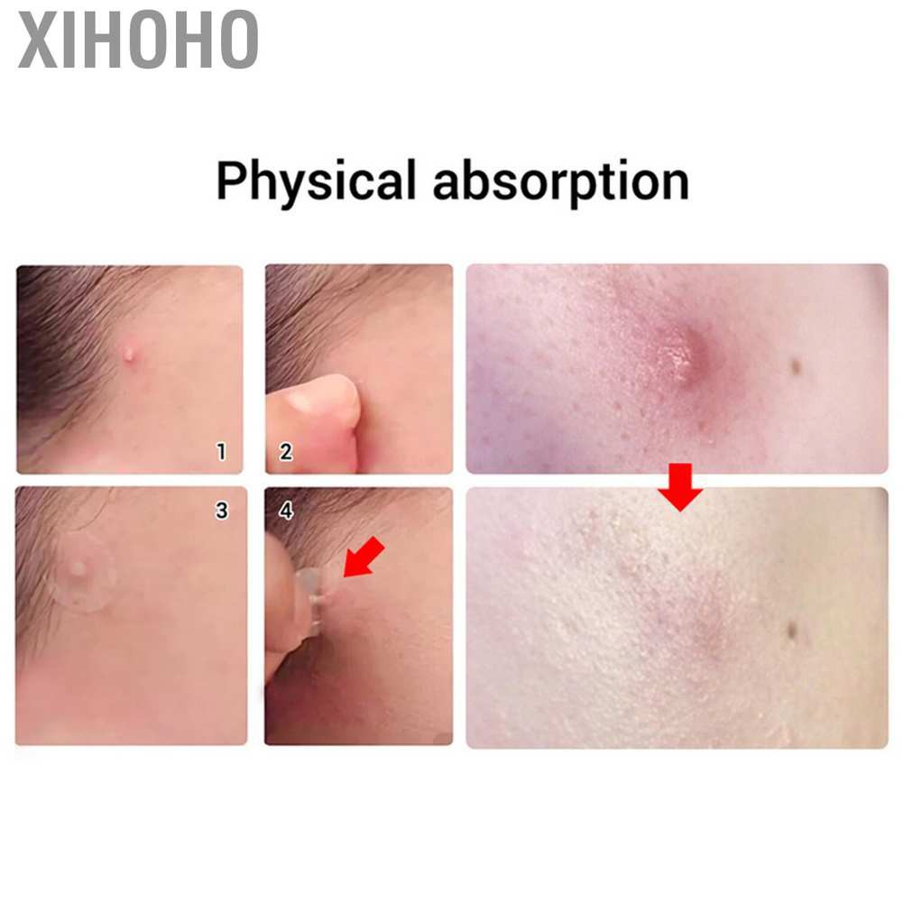 (hàng Mới Về) Miếng Dán Trị Mụn Tinh Chất Tràm Trà | BigBuy360 - bigbuy360.vn