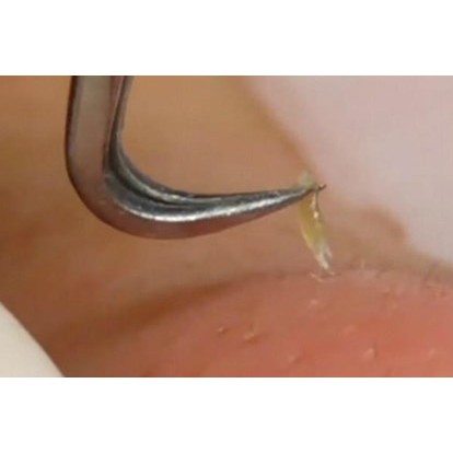 Nhíp cong gắp mụn thần thánh