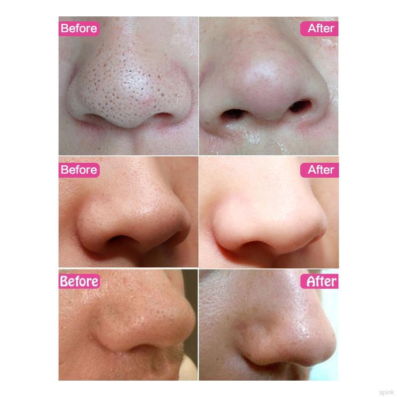 Mặt nạ loại bỏ mụn vùng mũi giúp kiểm soát dầu và làm sạch lỗ chân lông | BigBuy360 - bigbuy360.vn