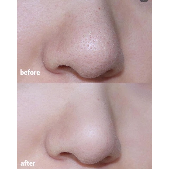 Gel lột mụn cám, mụn đầu đen, thải độc chì, sạch mụn, sáng da sau 1 lần đắp