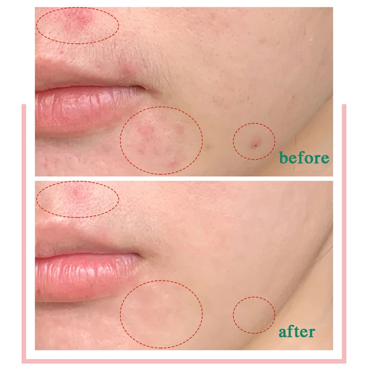 🦋giảm giá🦋Miếng pad tẩy da chết, hỗ trợ giảm mụn Stridex Daily Care Acne Pads with Salicylic Acid, Maximum Strength 55 Pads