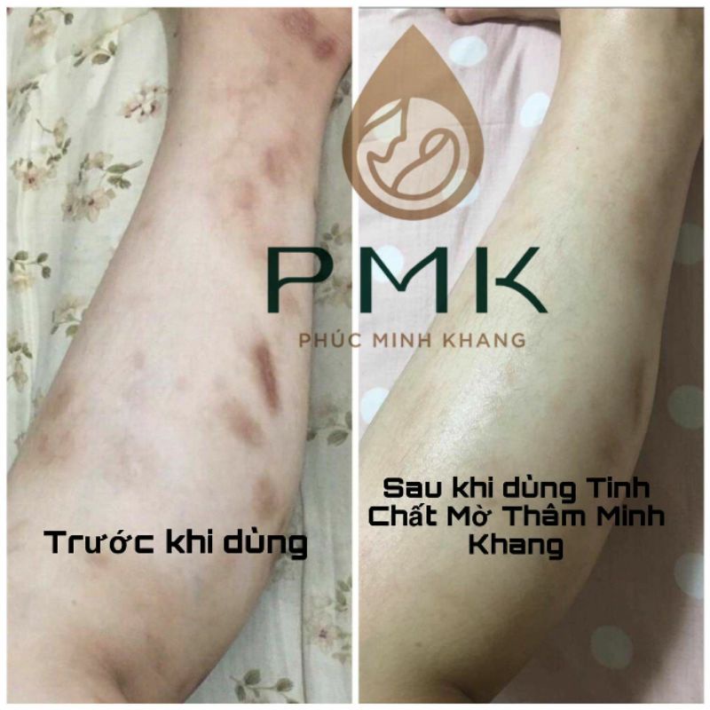 Tinh chất Xóa mờ thâm Minh Khang, Xoá thâm Sẹo,thâm mắt, thâm môi,thâm nách,thâm mụn - Chính Hãng