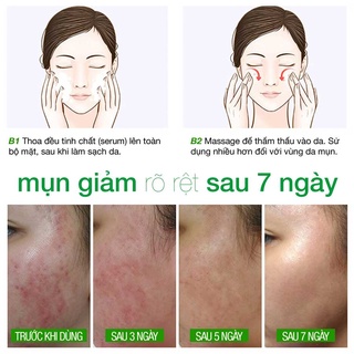 TINH CHẤT TẠM BIỆT MỤN BYE BYE BLEMISH for Acne 10ml LANGCE