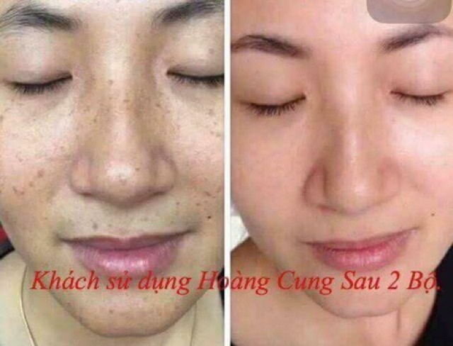 BỘ KEM HOÀNG CUNG 5 SẢN PHẨM SIÊU CẤP