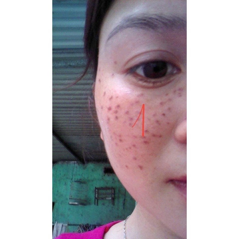 Chấm tàn nhang , nám ,mụn ruồi handmade | BigBuy360 - bigbuy360.vn