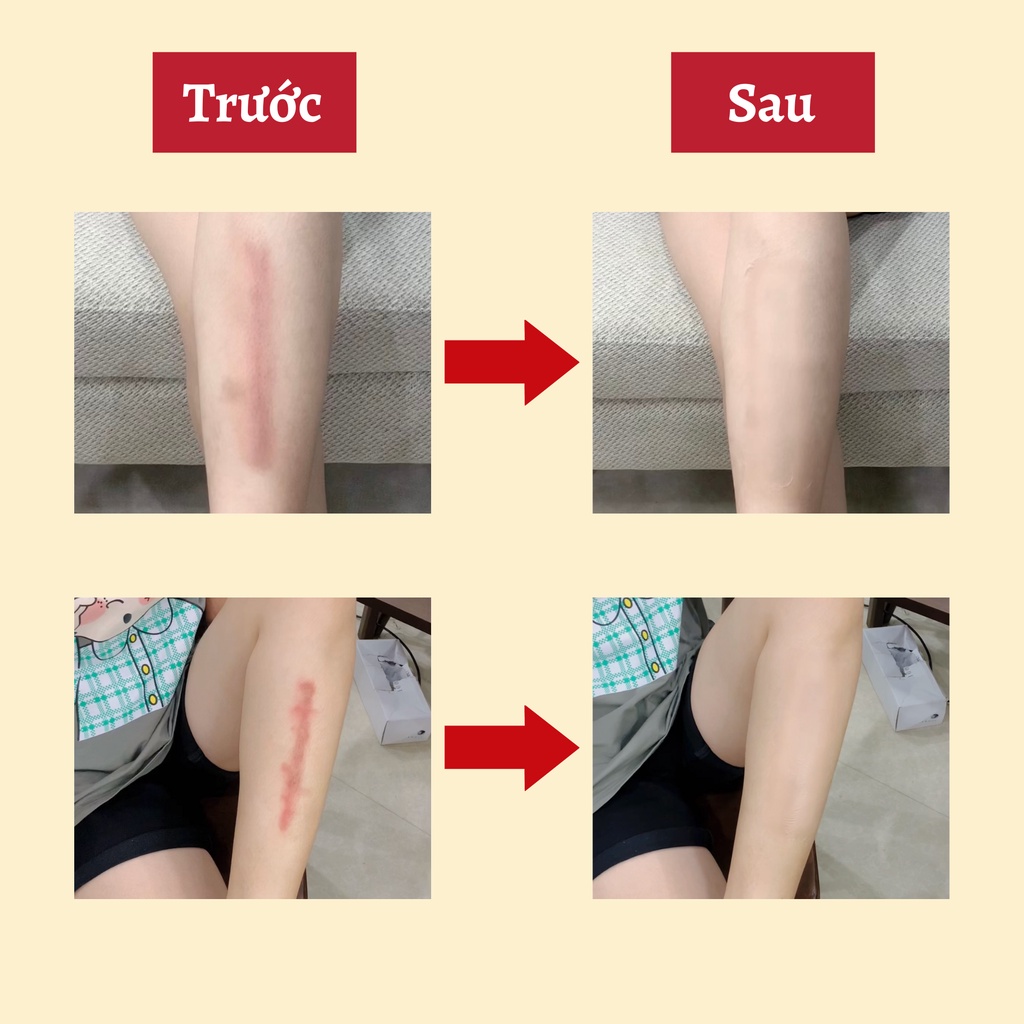 Miếng dán che sẹo che thâm đầu gối, vết bớt, Nhật Bản mỏng nhẹ, dễ dàng, chống nước