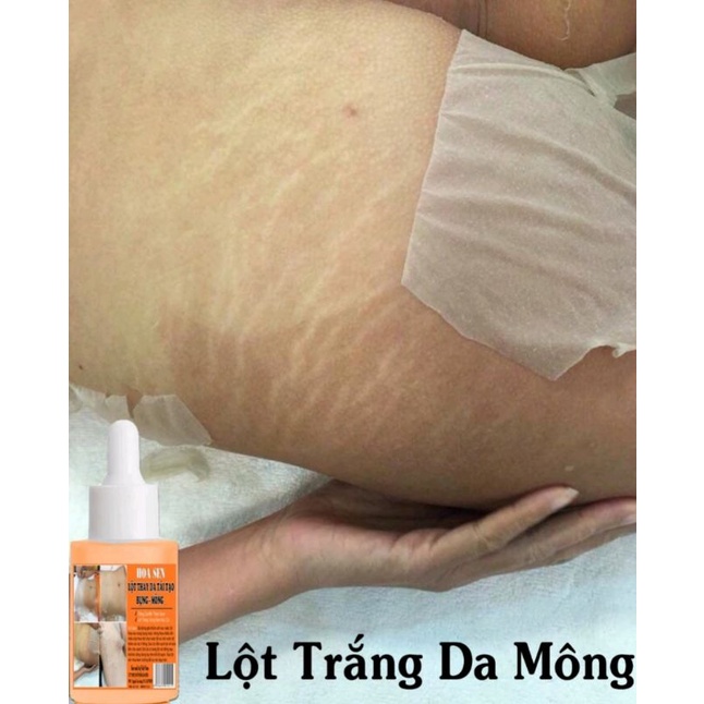 LỘT THAY DA MÔNG.HẾT THẰM MỜ RẠN.NỨT DA
