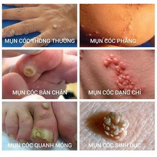 Miếng dán trị mụn cóc