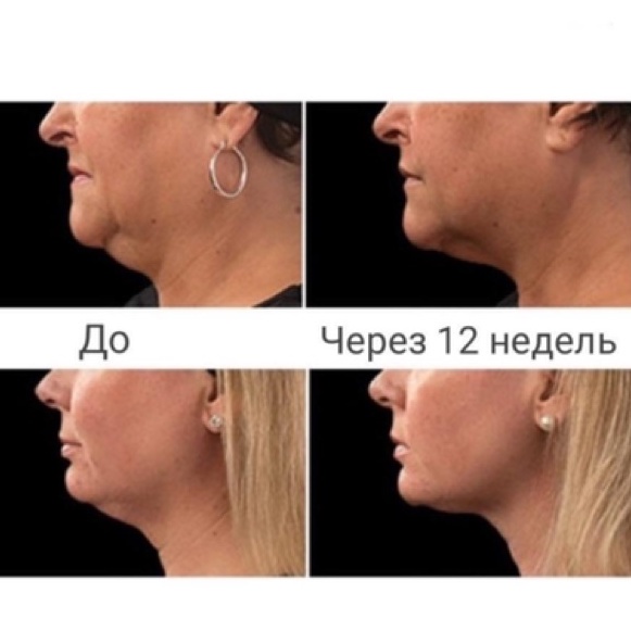 Kem Nâng Cơ Chống Chảy Xệ, Loại Bỏ Vùng Mỡ Thừa Ở Cằm, Cổ Novosvit Kpem 50ml Nga