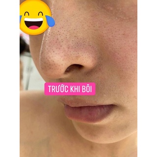Serum mụn Dr.lannes[Tặng cây nặn mụn]