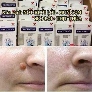 Gel Drelinil tẩy nốt ruồi Nga
