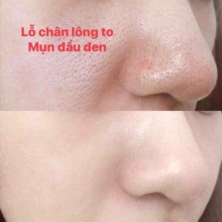 TINH CHẤT SE KHÍT LỖ CHÂN LÔNG SQS DEEP CONCENTRATE EXTRA