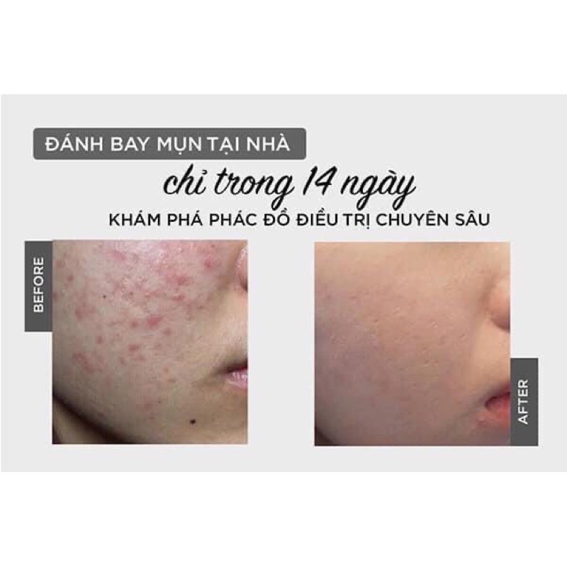 Serum tri mun được dùng cho spa