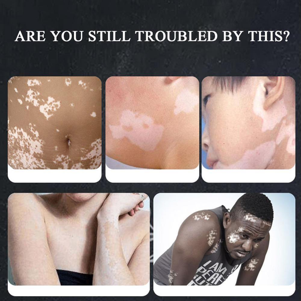 Kem dưỡng trắng da cao cấp Vitiligo 30g
