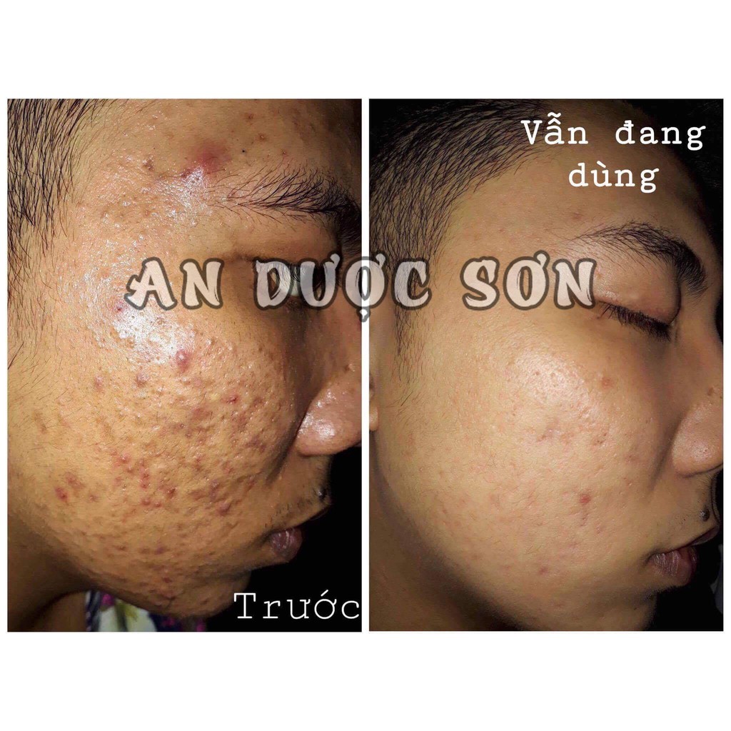 Serum Hết Mụn Tận Gốc An Dược Sơn - Tái Tạo Da Sạch Thâm Nám, Tàn Nhang, Sẹo Rỗ - Chai 3