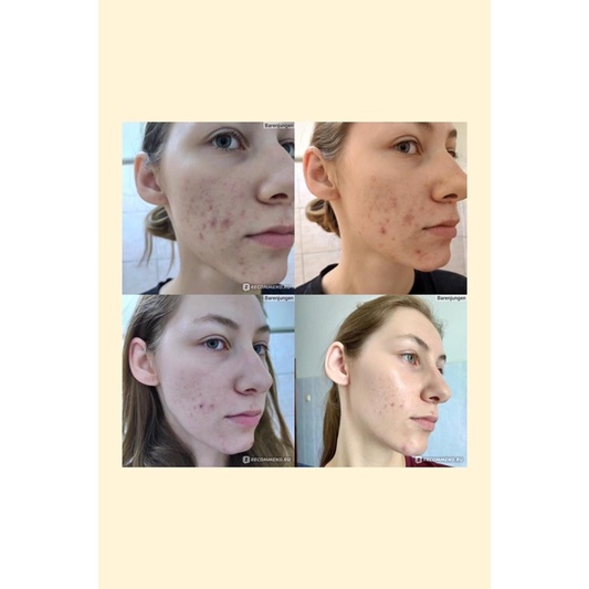 Gel chấm mụn Biretix Tri Active