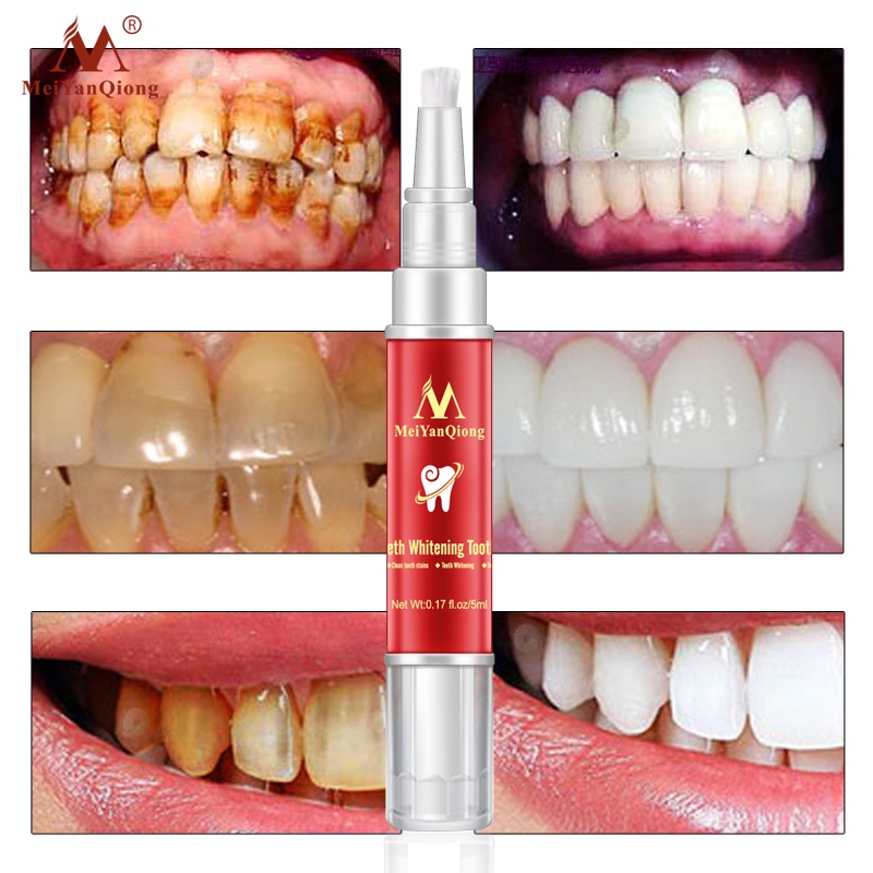 Bút Tẩy Trắng Răng Khử Mùi Hôi Miệng Làm Sạch Răng Tẩy Vết Ố Răng Teeth Treatment Whitening Meiyanqiong 5Ml