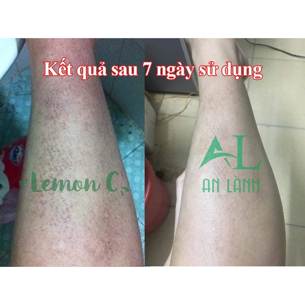 Tắm tẩy thiên nhiên Lemon C Tẩy tbc, viêm nang lông