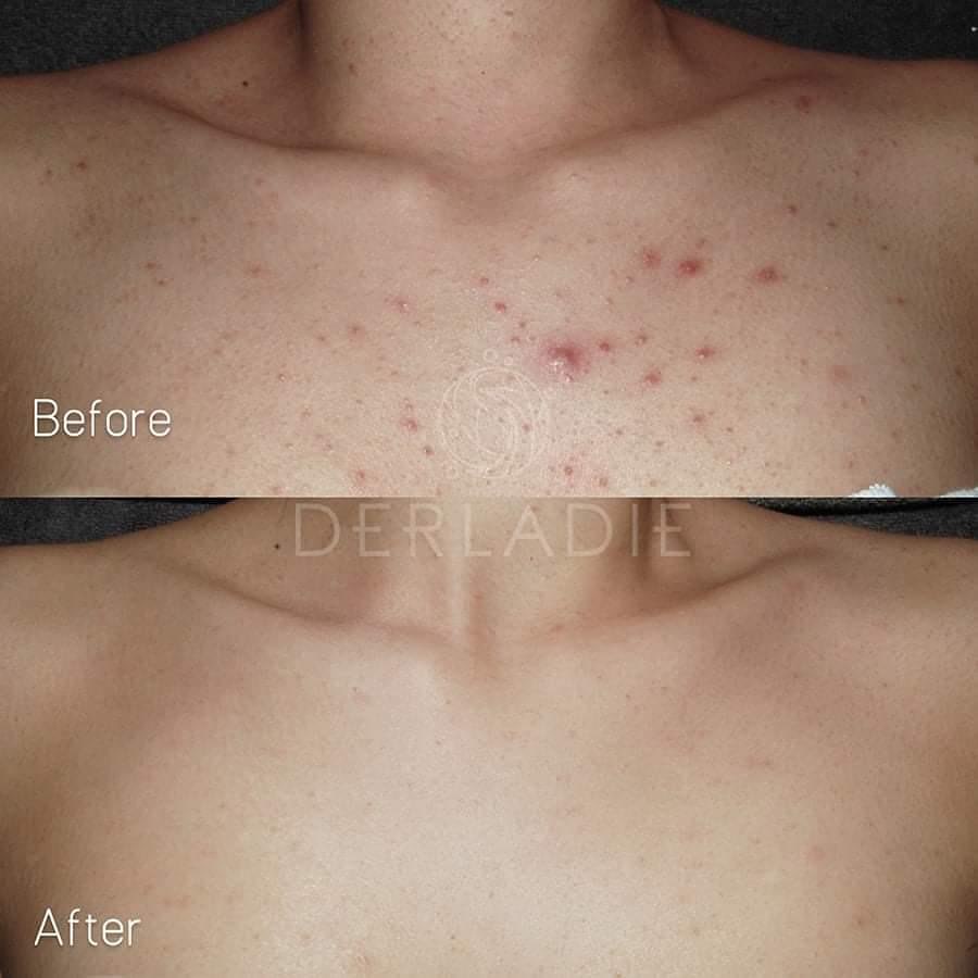 Xà phòng giảm mụn cơ thể sau 7 ngày Derladie Body Cleansing Bar For Blemish Skin 50g