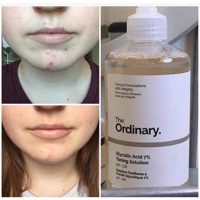 [Kèm bill] 240ml - Toner tẩy da chết 240ml Glycolic Acid 7% Toning Solution The Ordinary | BigBuy360 - bigbuy360.vn