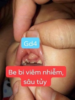 Thảo dược về răng miệng Lợi An